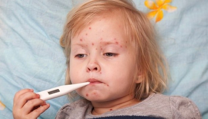 Mon bébé a la varicelle - Bébés et Mamans