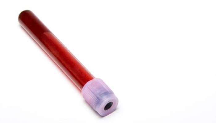 Tube de sang pour dépistage de l'anémie chez l'enfant Tube de sang pour dépistage de l'anémie chez l'enfant