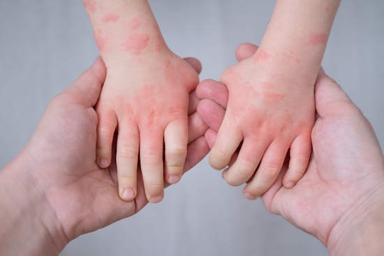 Gros plan sur les mains d'un petit enfant qui fait une réaction allergique