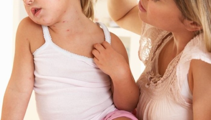 Enfant souffrant de psoriasis Enfant souffrant de psoriasis