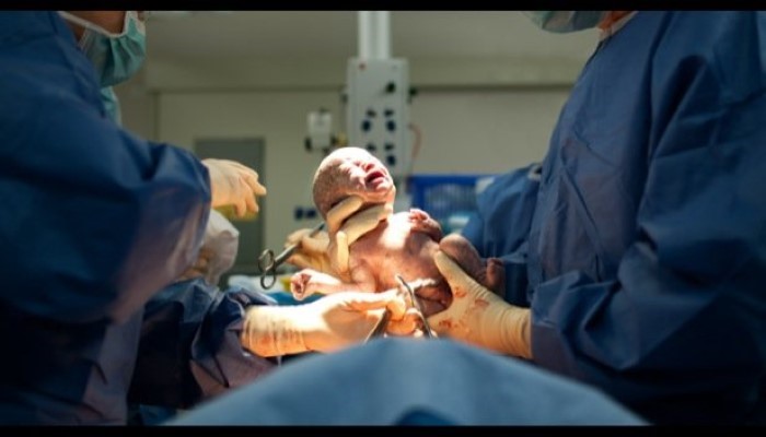Au bloc opératoire : bébé qui naît par césarienne Au bloc opératoire : bébé qui naît par césarienne