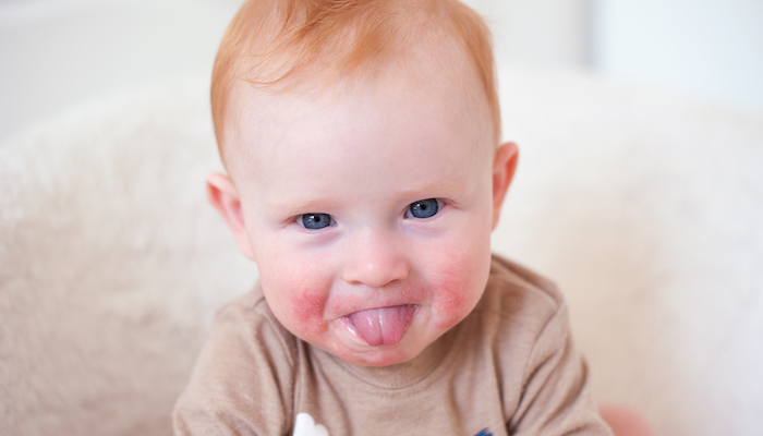 Dermatite atopique et allergie