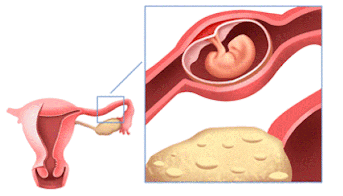 Type de Grossesse extra-utérine Type de Grossesse extra-utérine