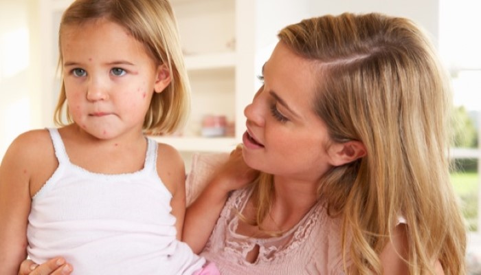 Allergies aux fruits secs Allergies aux fruits secs