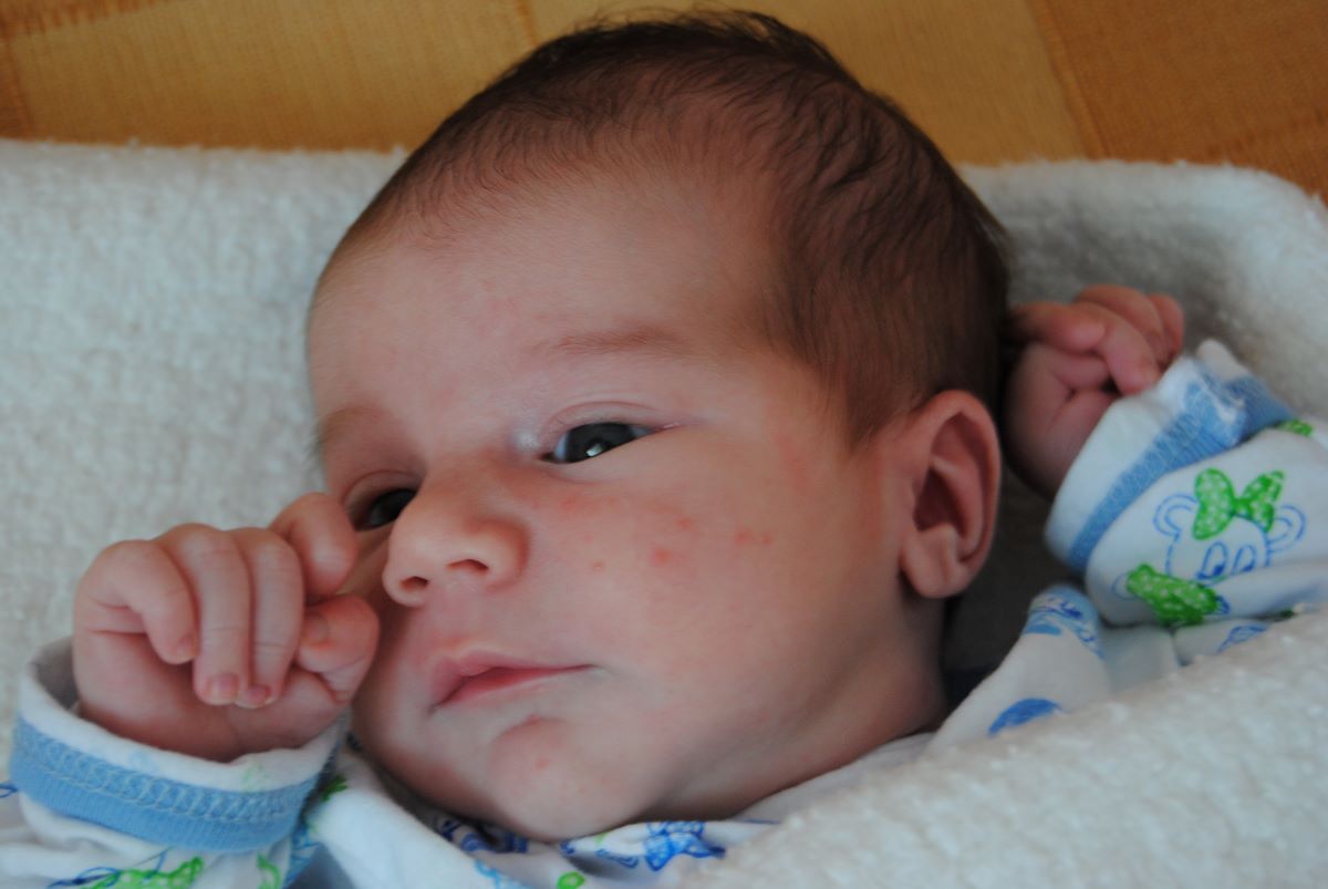 La varicelle est-elle dangereuse chez un bébé de 4 mois ? La varicelle est-elle dangereuse chez un bébé de 4 mois ?