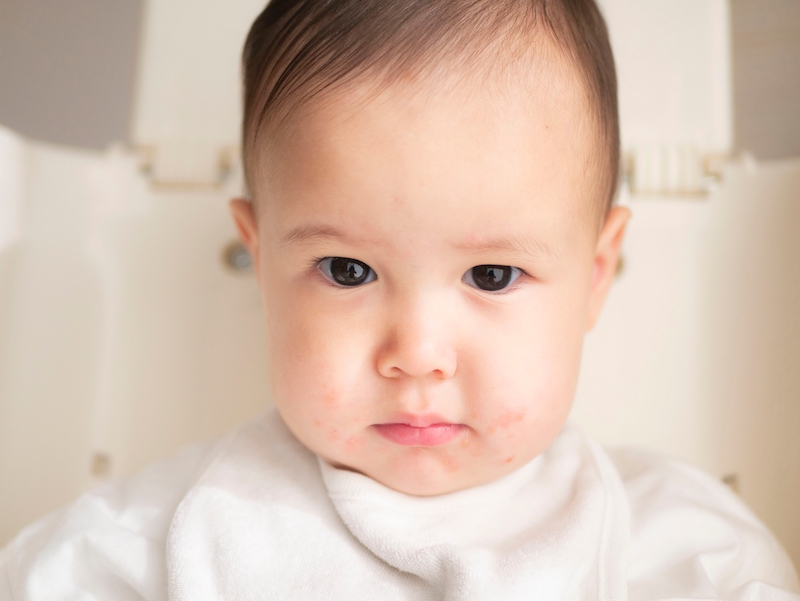 Mon bébé a des boutons autour de la bouche