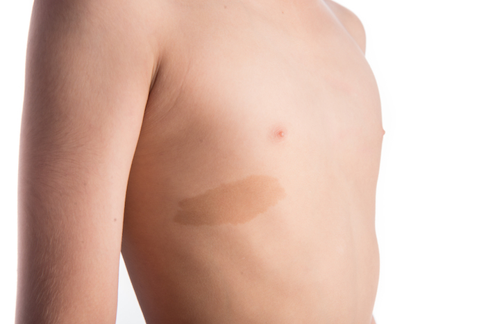 Une tache sur la peau d'un enfant Une tache sur la peau d'un enfant