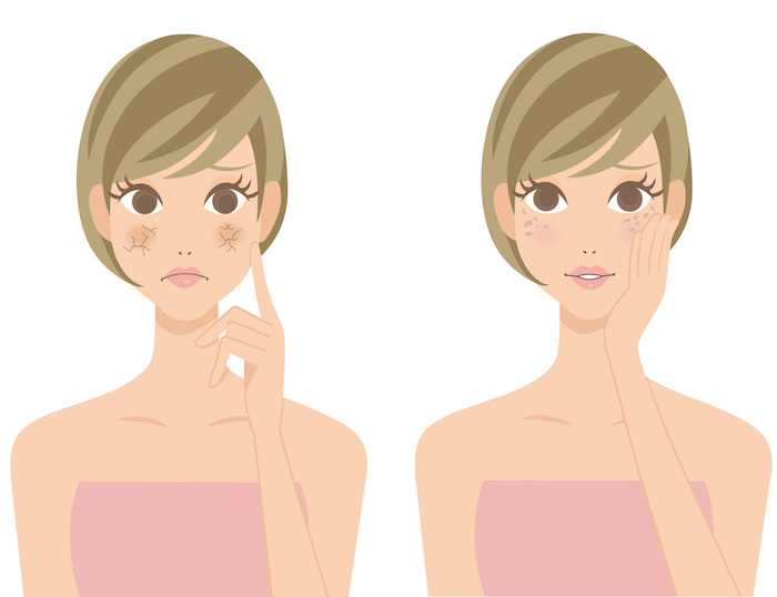 Une jeune femme qui a des taches sur le visage