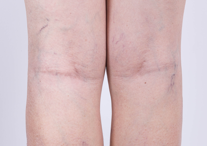 Des jambes avec des varices