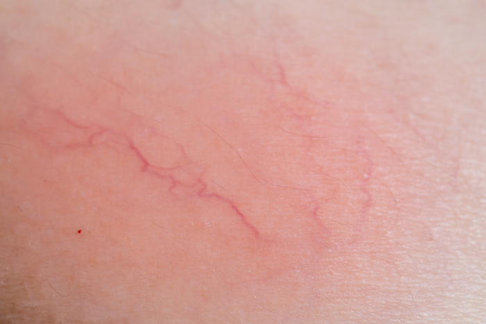 Des varicosités Des varicosités