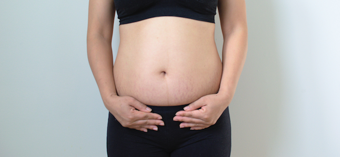 Une femme qui a des vergetures sur le ventre Une femme qui a des vergetures sur le ventre