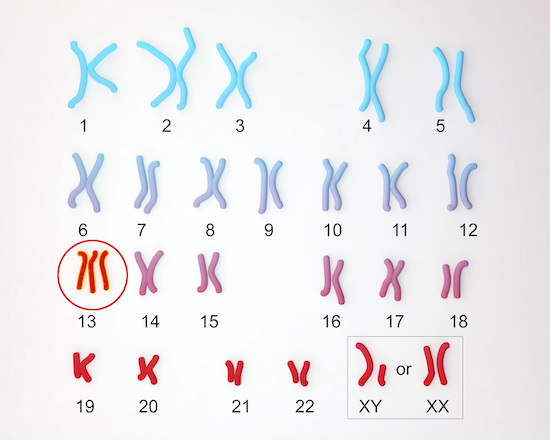 Les types de trisomie