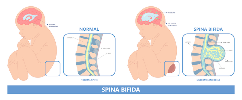 Spina bidida