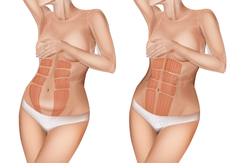 Exemple de diastasis abdominale