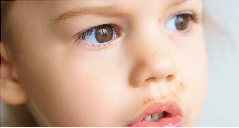 Molluscum Contagiosum chez les Enfants