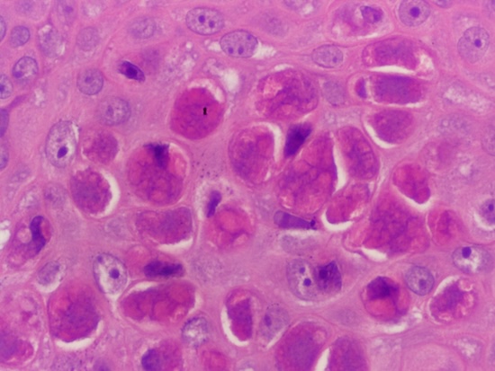 Molluscum contagiosum au microscope