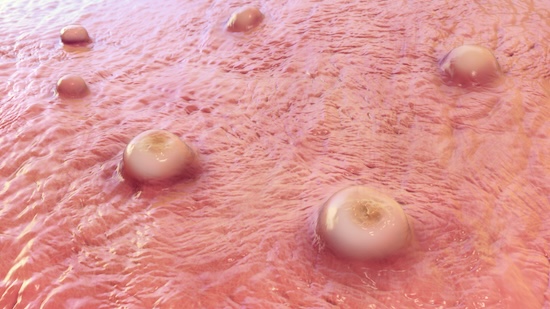 Photos de Molluscum Contagiosum