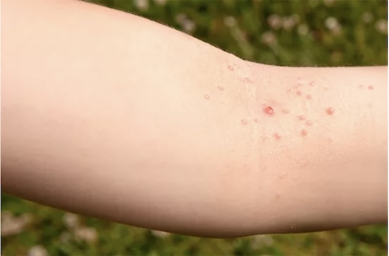 Photos de Molluscum Contagiosum