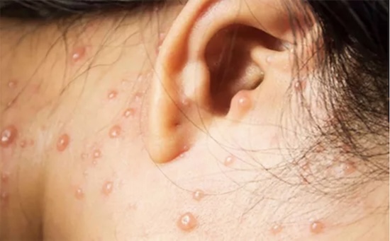 Photos de Molluscum Contagiosum