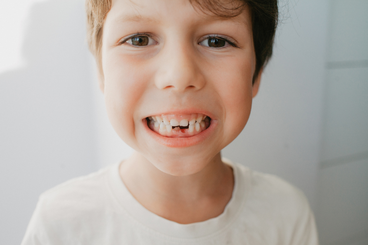 Chute des dents de lait