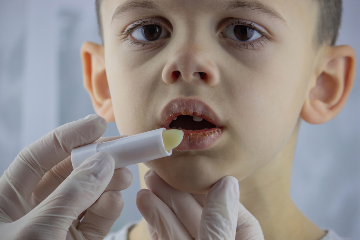 Lèvres gercées et nez irrité chez l’enfant en hiver