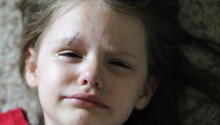 Points de suture chez l'enfant Points de suture chez l'enfant